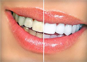 Teeth Whitening | Brian Yee DDS | Cleveland OH 44114